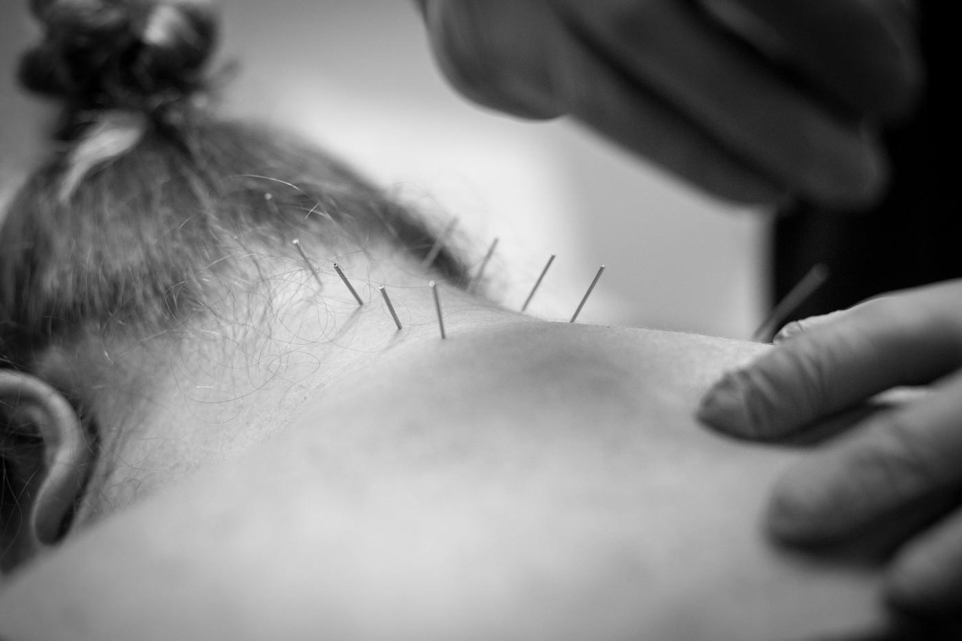 branding photographer memphis tennessee prefocus solutions close up of dry needling on neck of physical therapy patient black and white website portraits ob ms